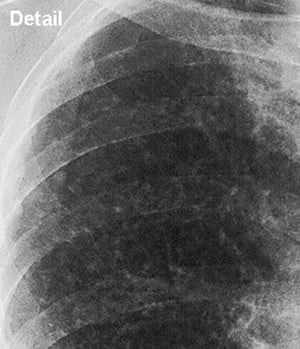 Silicose, simple (champ pulmonaire supérieur)