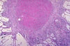 Silicotic Nodule