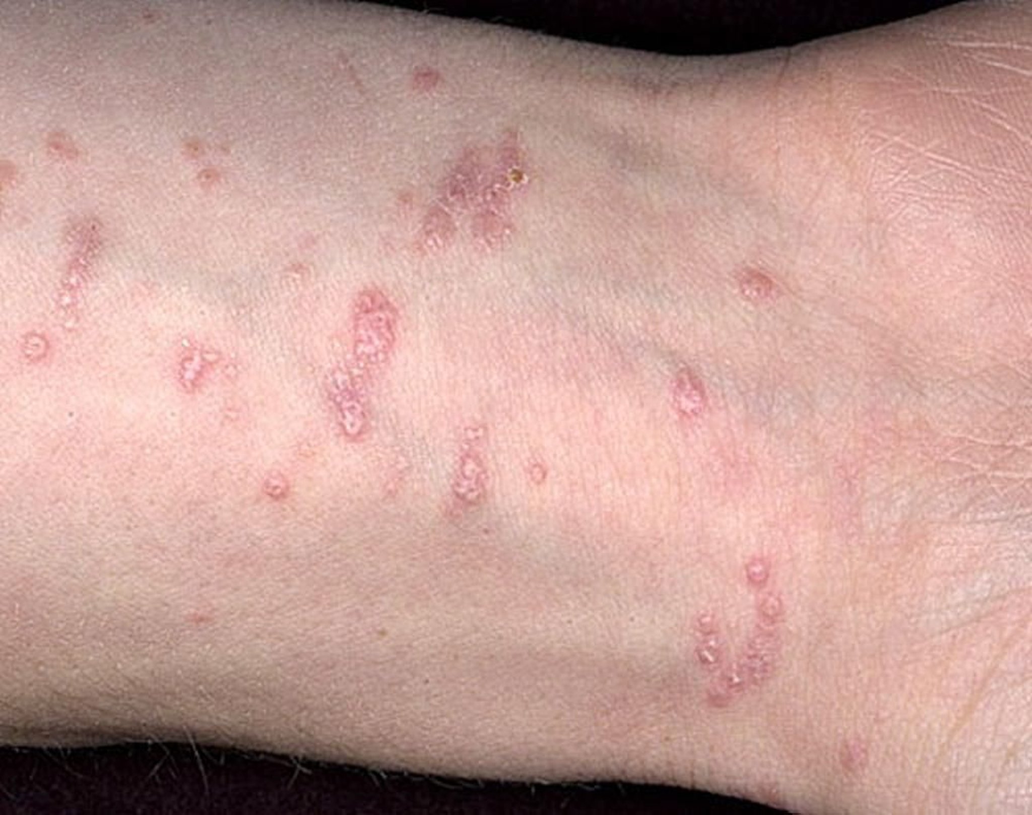 Lésion cutanée (papule)