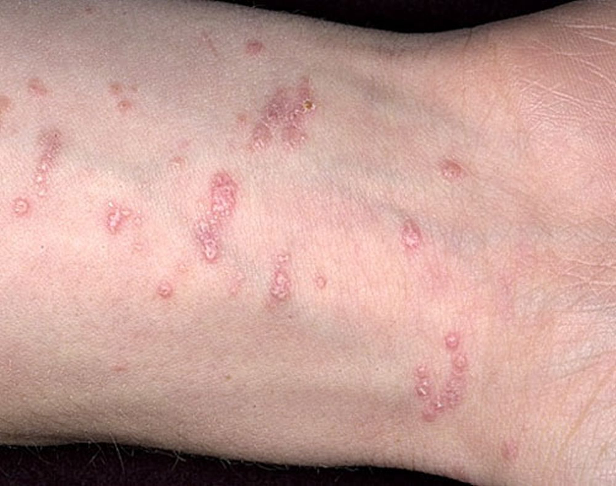 Skin Lesion (Papule)