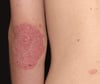 Plaque psoriasique