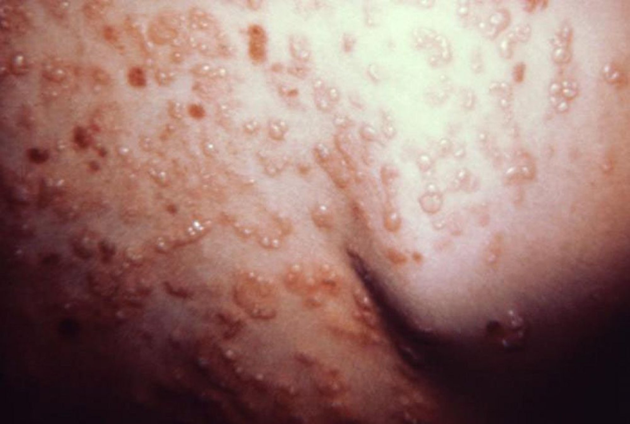 Skin Lesion (Vesicle)