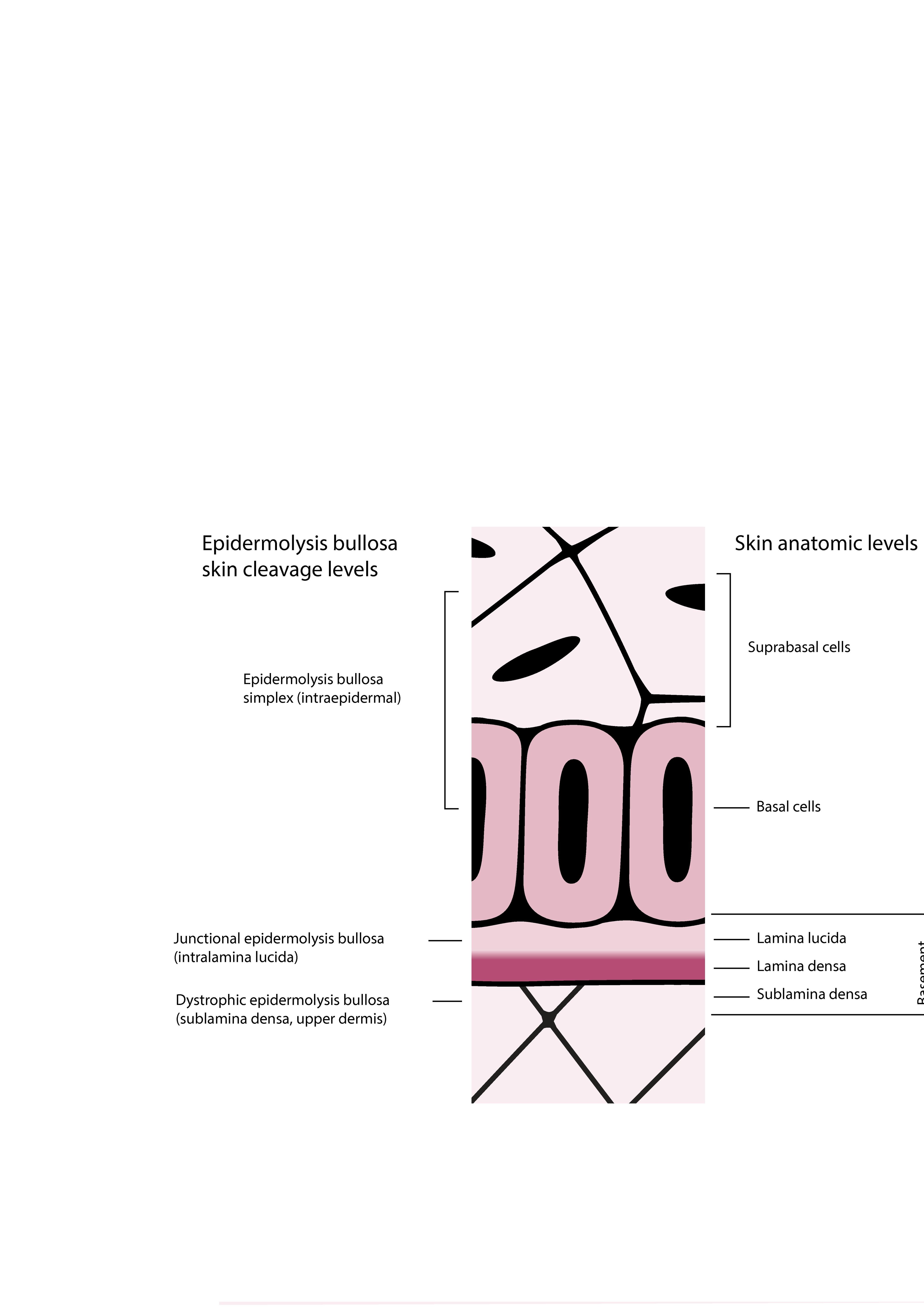 Niveles de escisión de la piel en la epidermólisis ampollosa