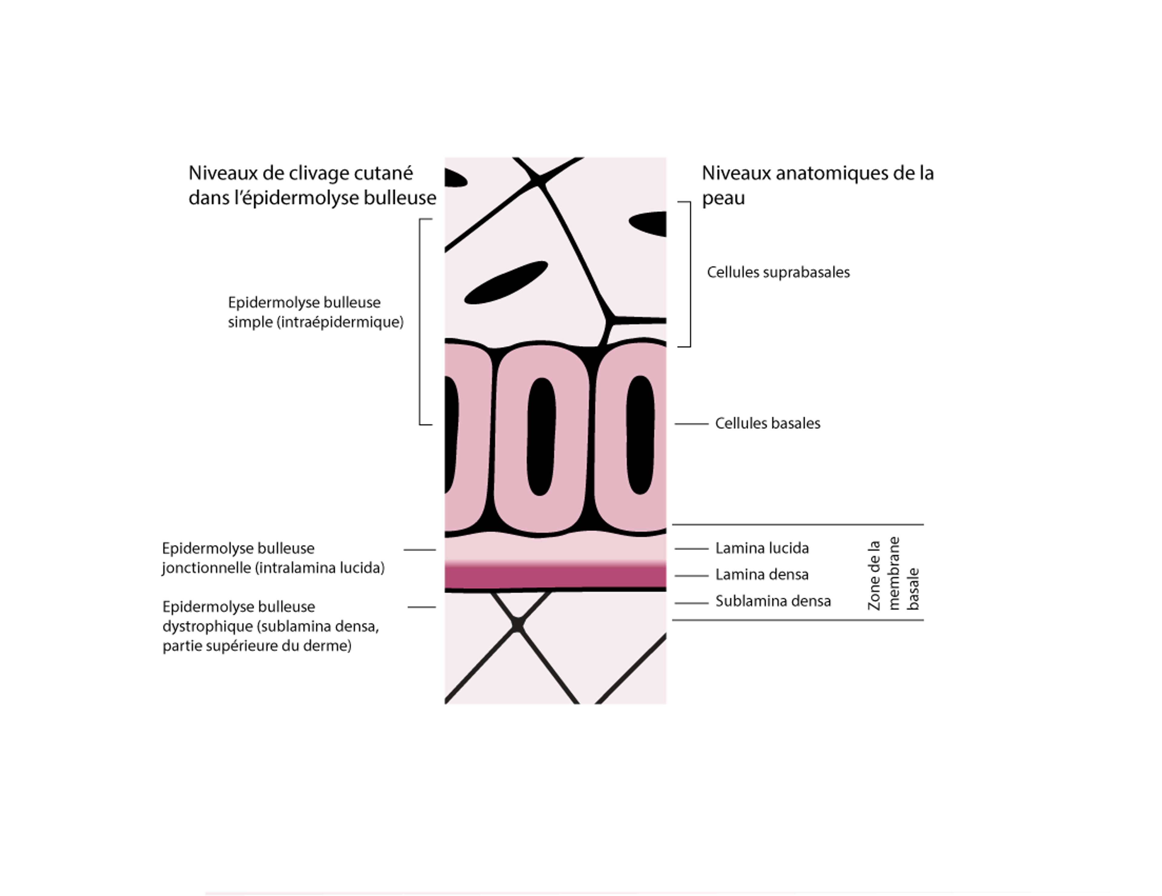 Niveaux de clivage cutané dans l'épidermolyse bulleuse