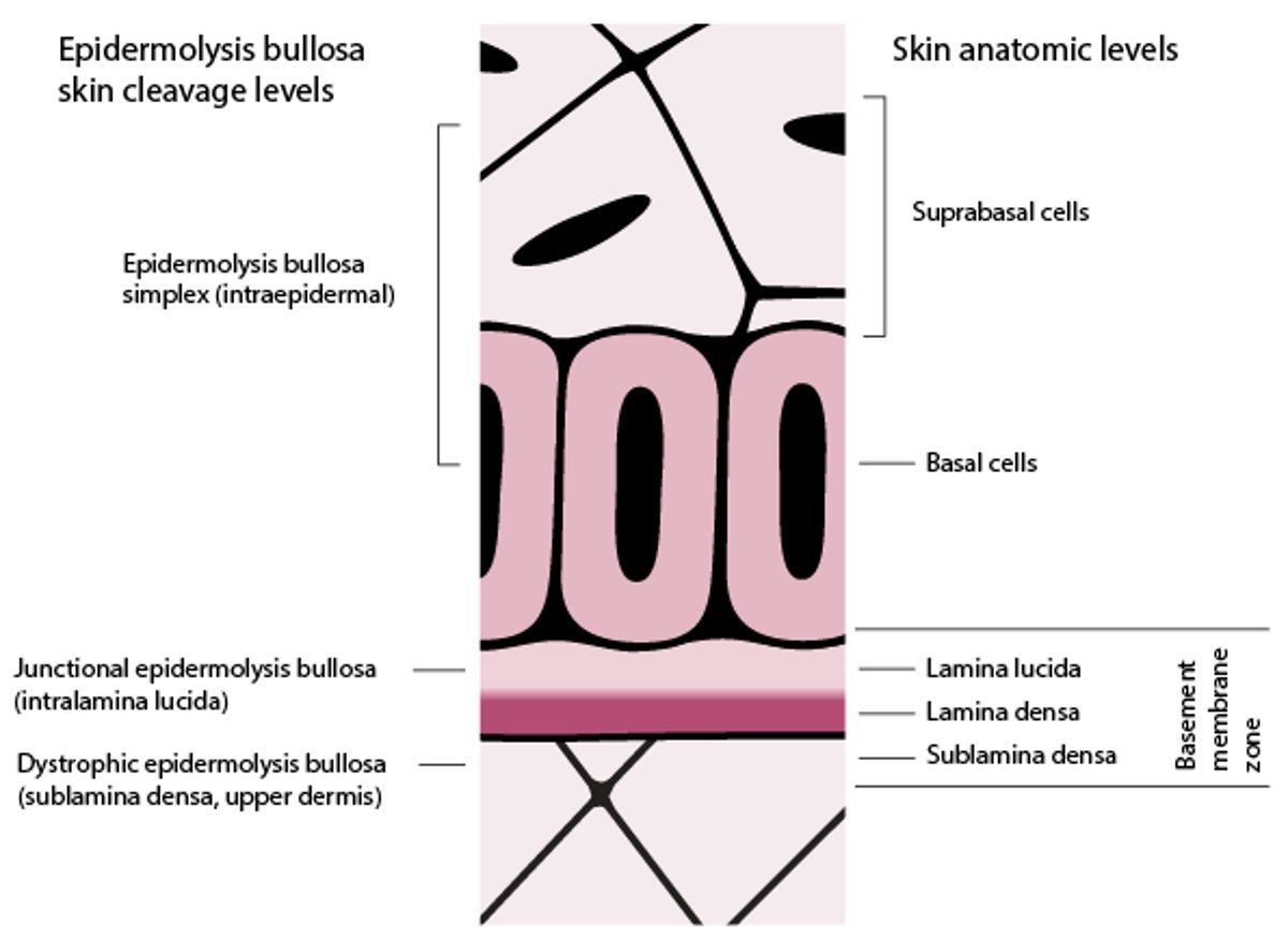 Рівні відшарування шкіри при бульозному епідермолізі