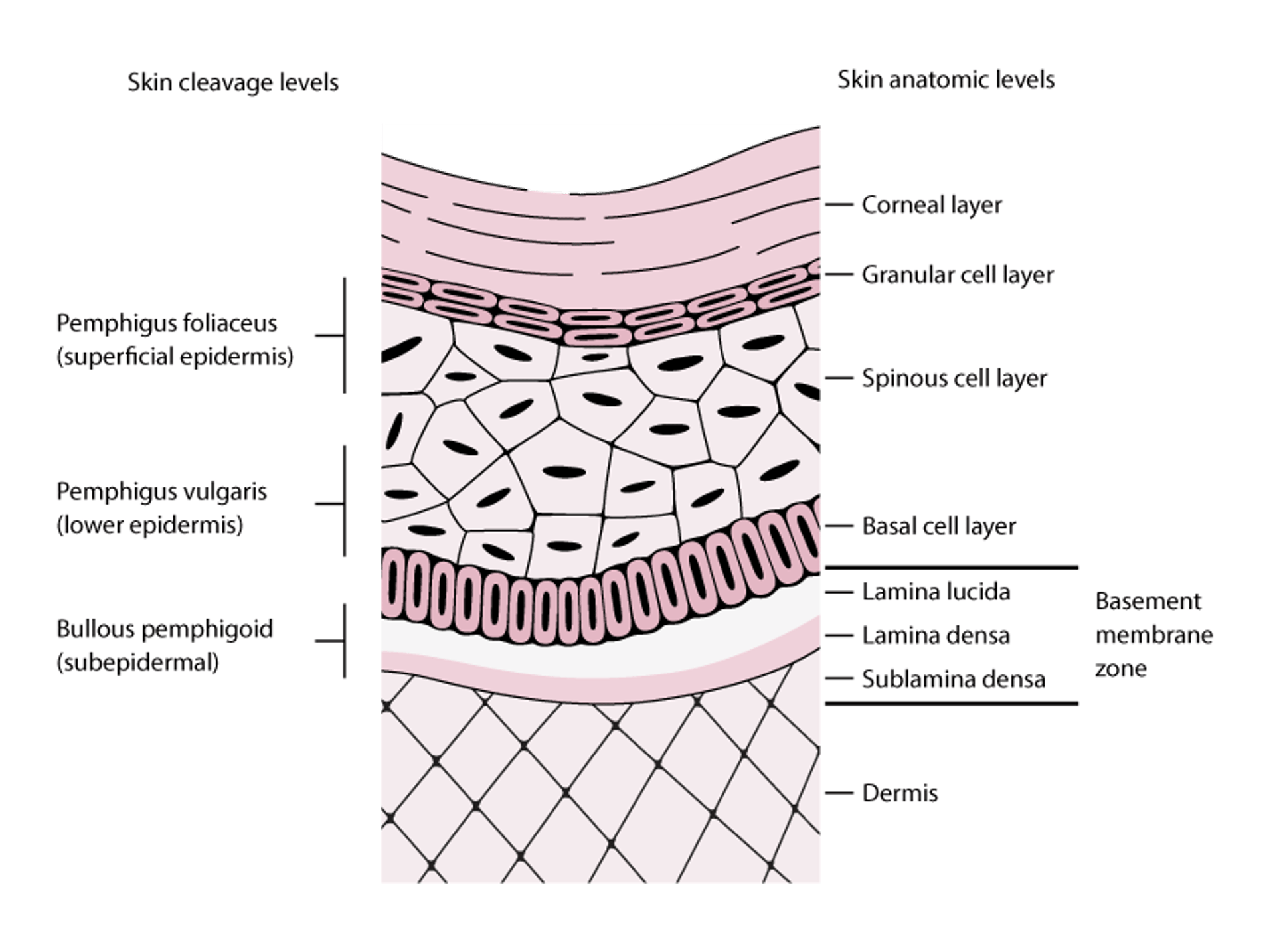 Skin Cleavage Levels in Pemphigus and Bullous Pemphigoid