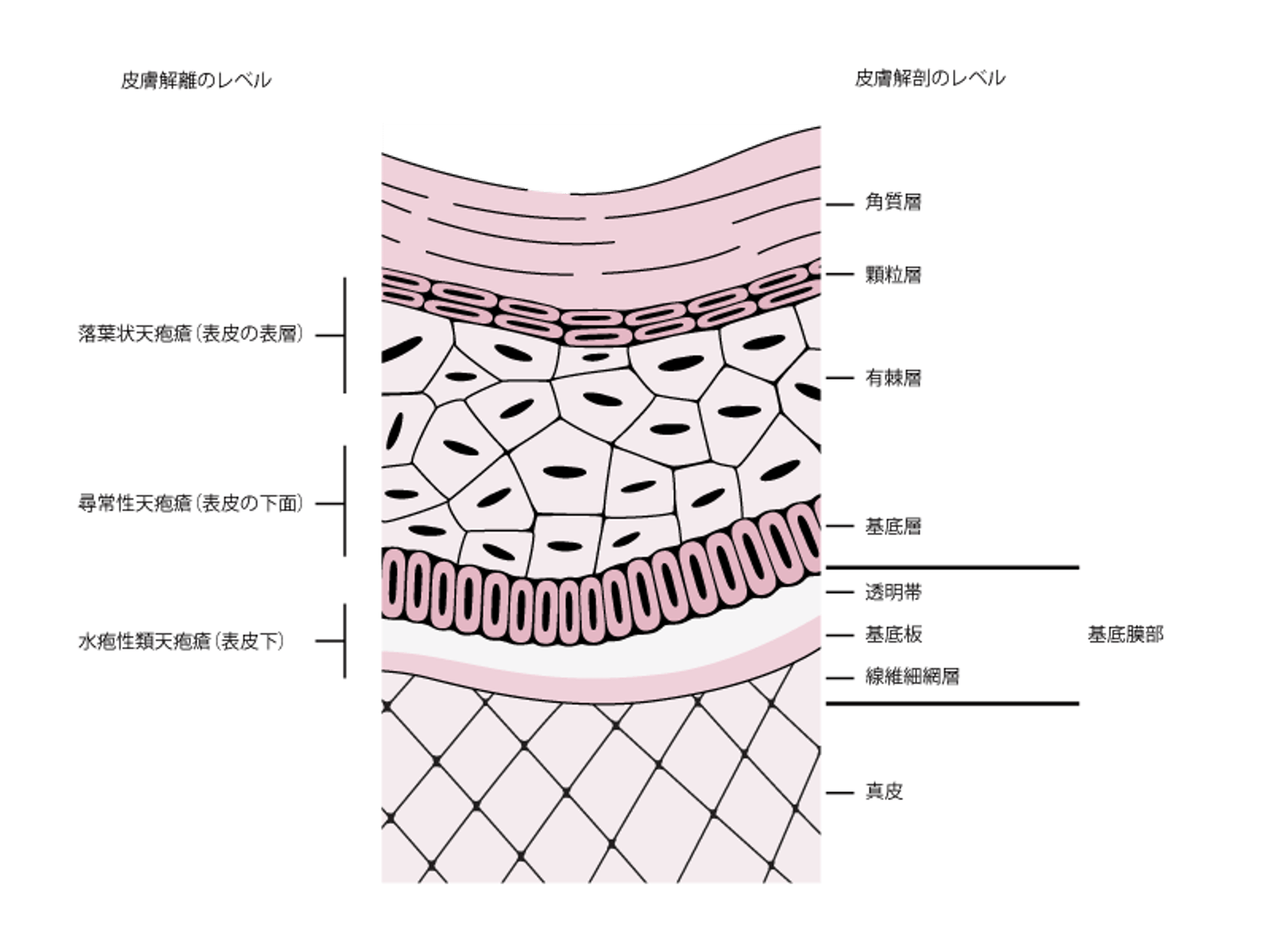 天疱瘡および水疱性類天疱瘡における皮膚離開のレベル