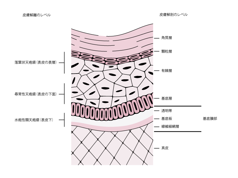 落葉状天疱瘡 - 14. 皮膚疾患 - MSDマニュアル プロフェッショナル版 Illustration 