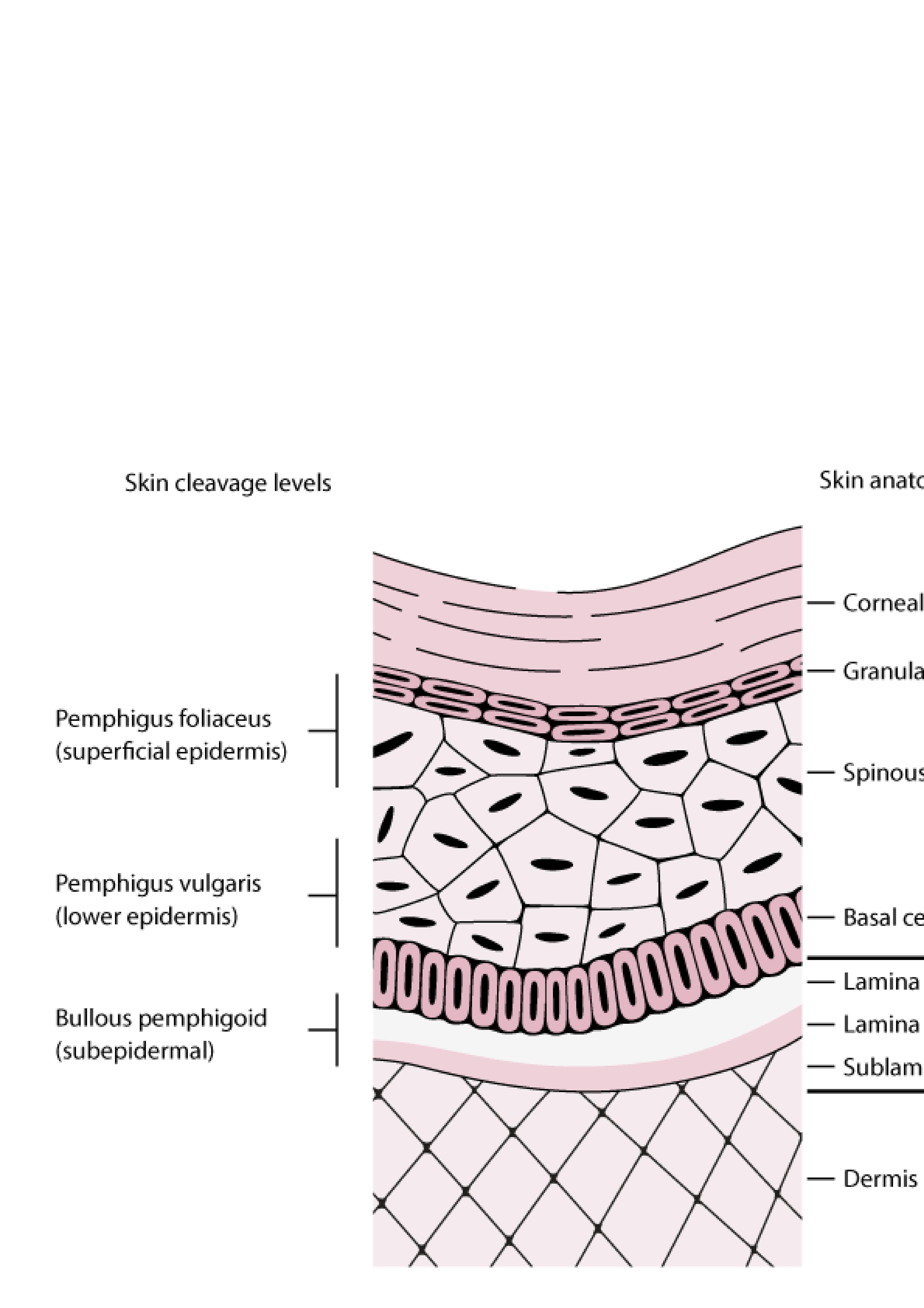 Níveis de clivagem cutânea no pênfigo e penfigoide bolhoso