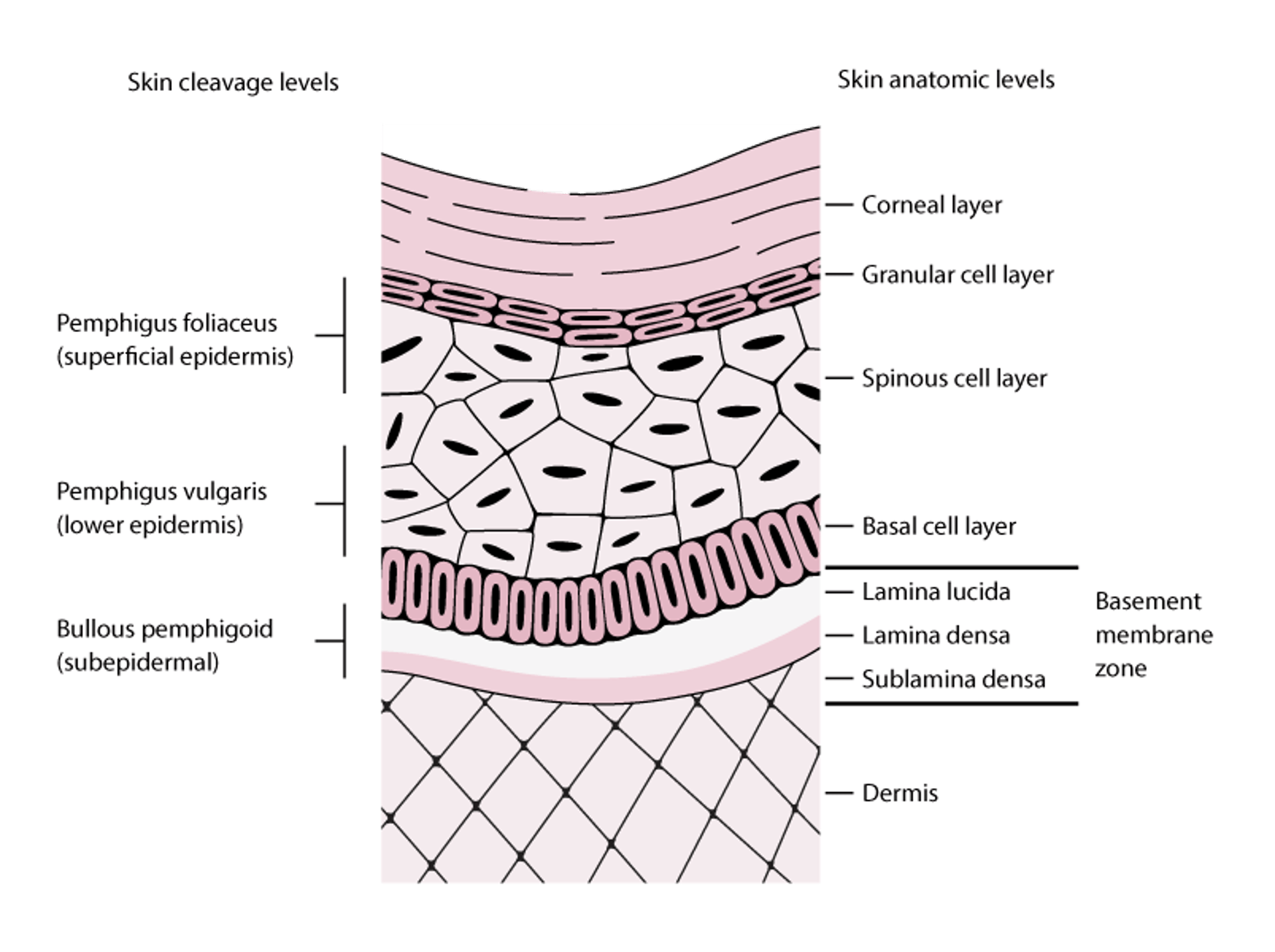 Рівні відшарування шкіри при пухирчатці та бульозному пемфігоїді