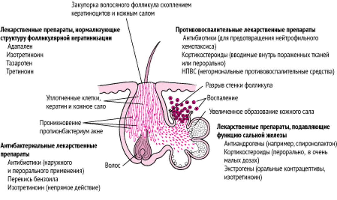 Как различные препараты действуют при лечении акне