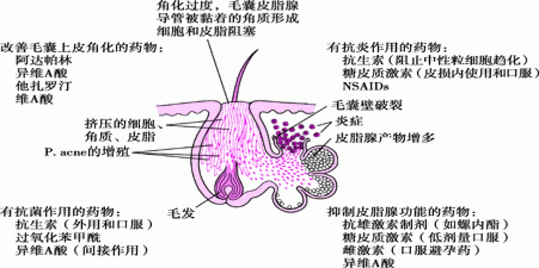 不同药物治疗痤疮的机制