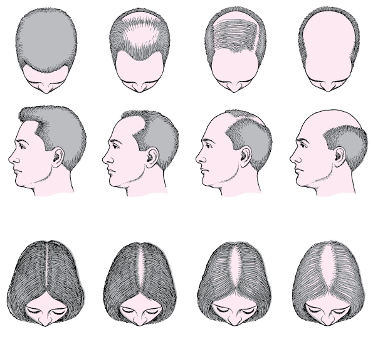 Haarausfall bei Männern und bei Frauen (androgenetische Alopezie)