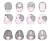 Patrones masculino y femenino de pérdida del cabello (alopecia androgénica)