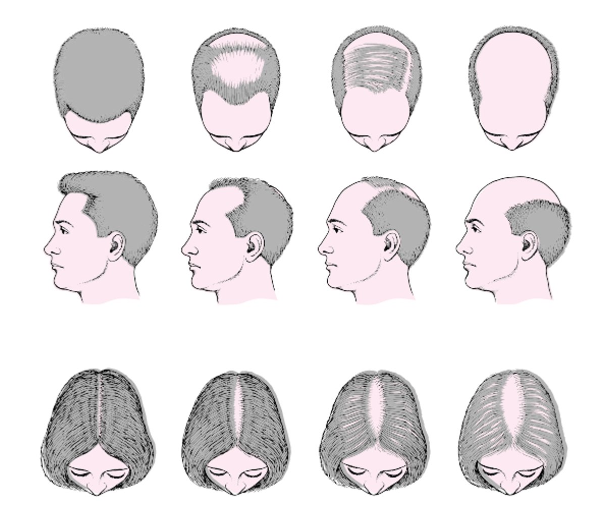 Patrones masculino y femenino de pérdida del cabello (alopecia androgénica)