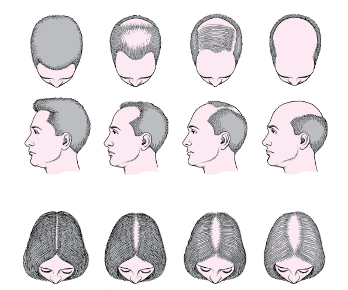 Perte des cheveux de modèle masculin et féminin (alopécie androgénétique)
