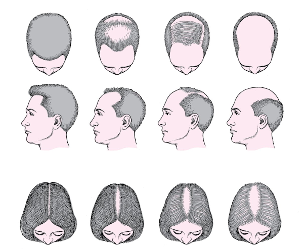 Alopecia di tipo maschile e femminile (alopecia androgenetica)