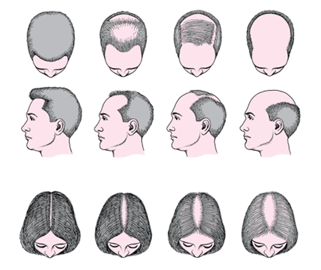 Alopecia do couro cabeludo e corpo do tipo masculino e feminino (alopecia androgenética)