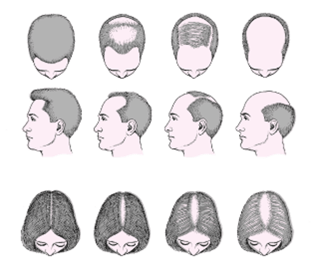 Rụng tóc kiểu hói nam và nữ (chứng rụng tóc nội tiết tố androgenetic)