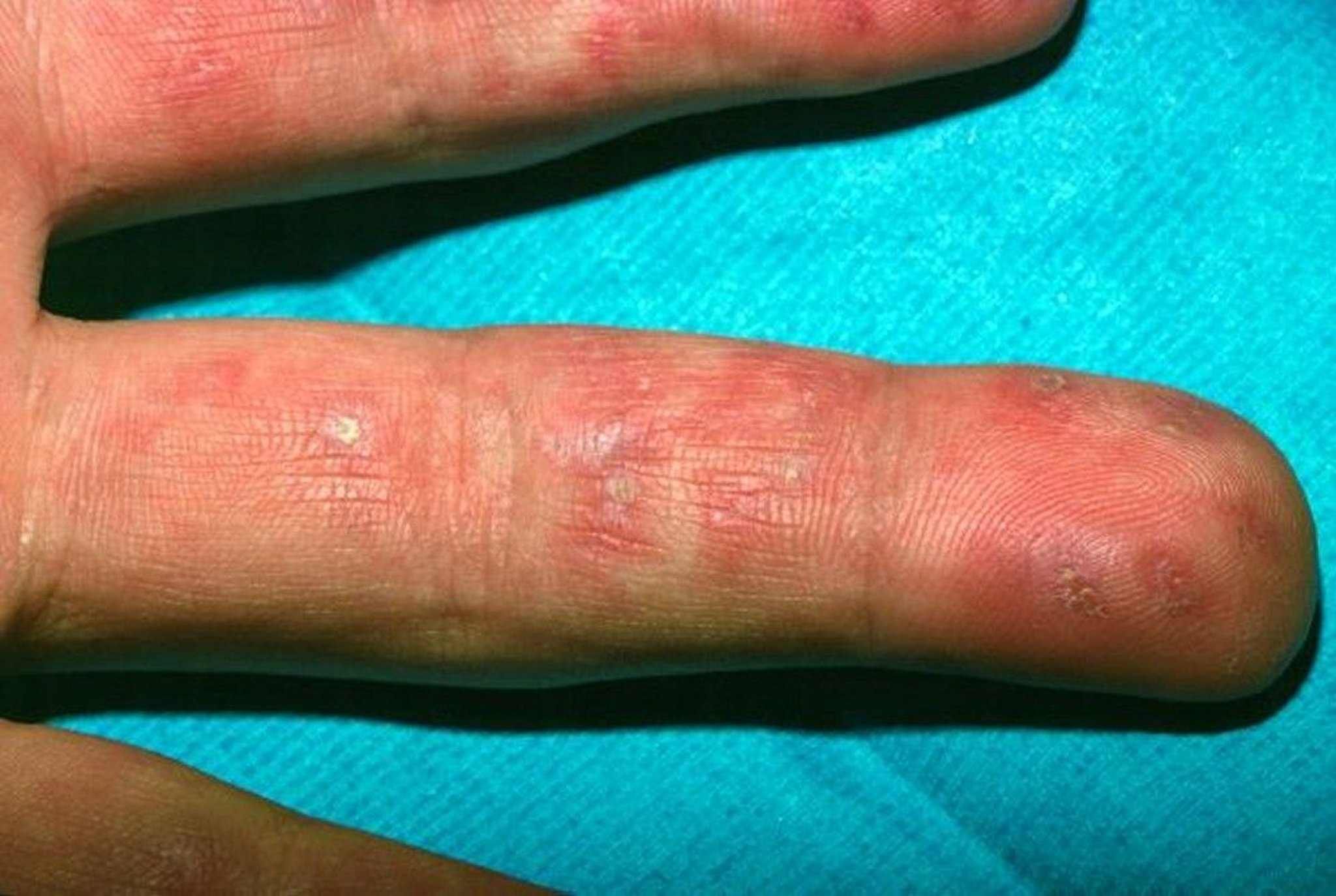 Discoid Lupus (Fingers)