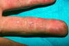 Lupus discoïde (doigts)