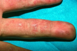 Lupus discoïde (doigts)
