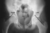 Slipped Capital Femoral Epiphysis (SCFE)