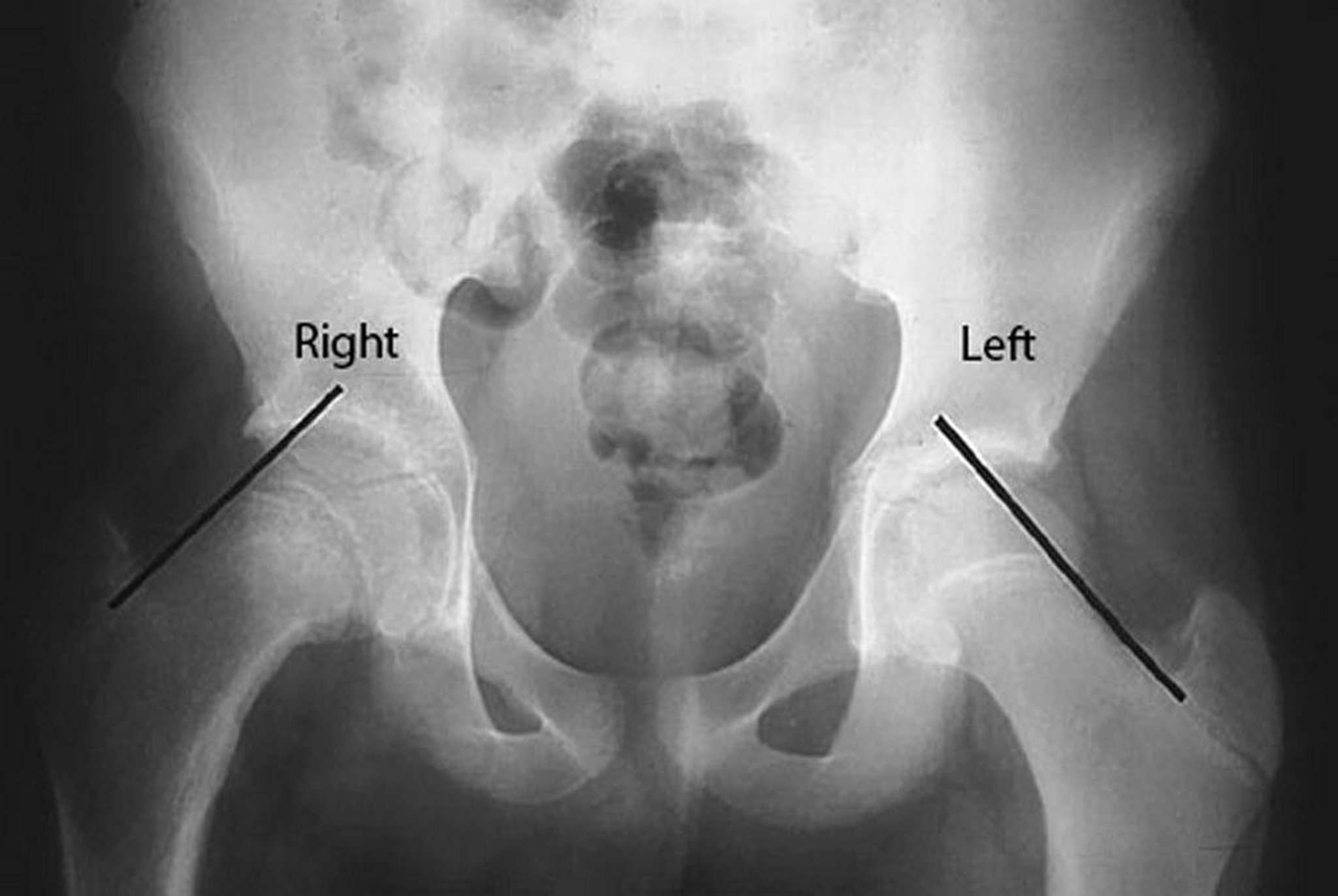Slipped Capital Femoral Epiphysis (SCFE)