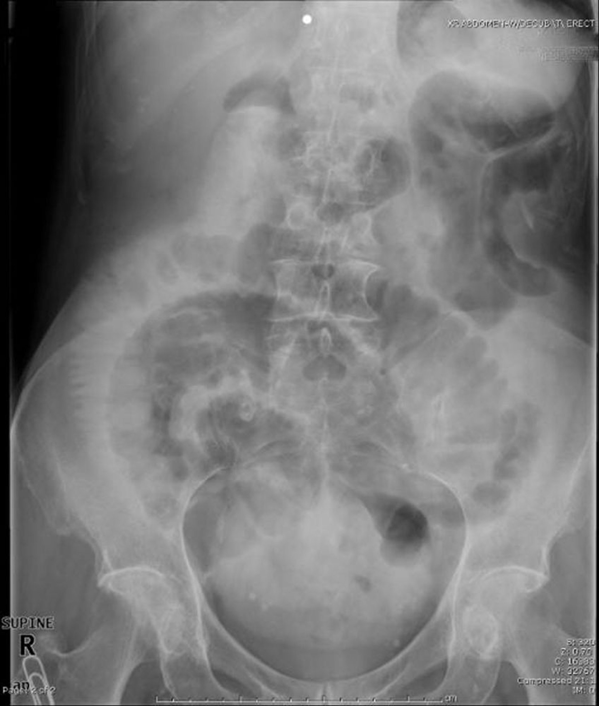 Тонкокишечная непроходимость (рентген в положении на спине)