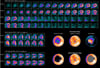 SPECT en angina de pecho de comienzo reciente