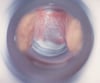 Examen con espéculo en la vaginosis bacteriana