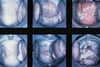 Examen con espéculo en la vaginitis