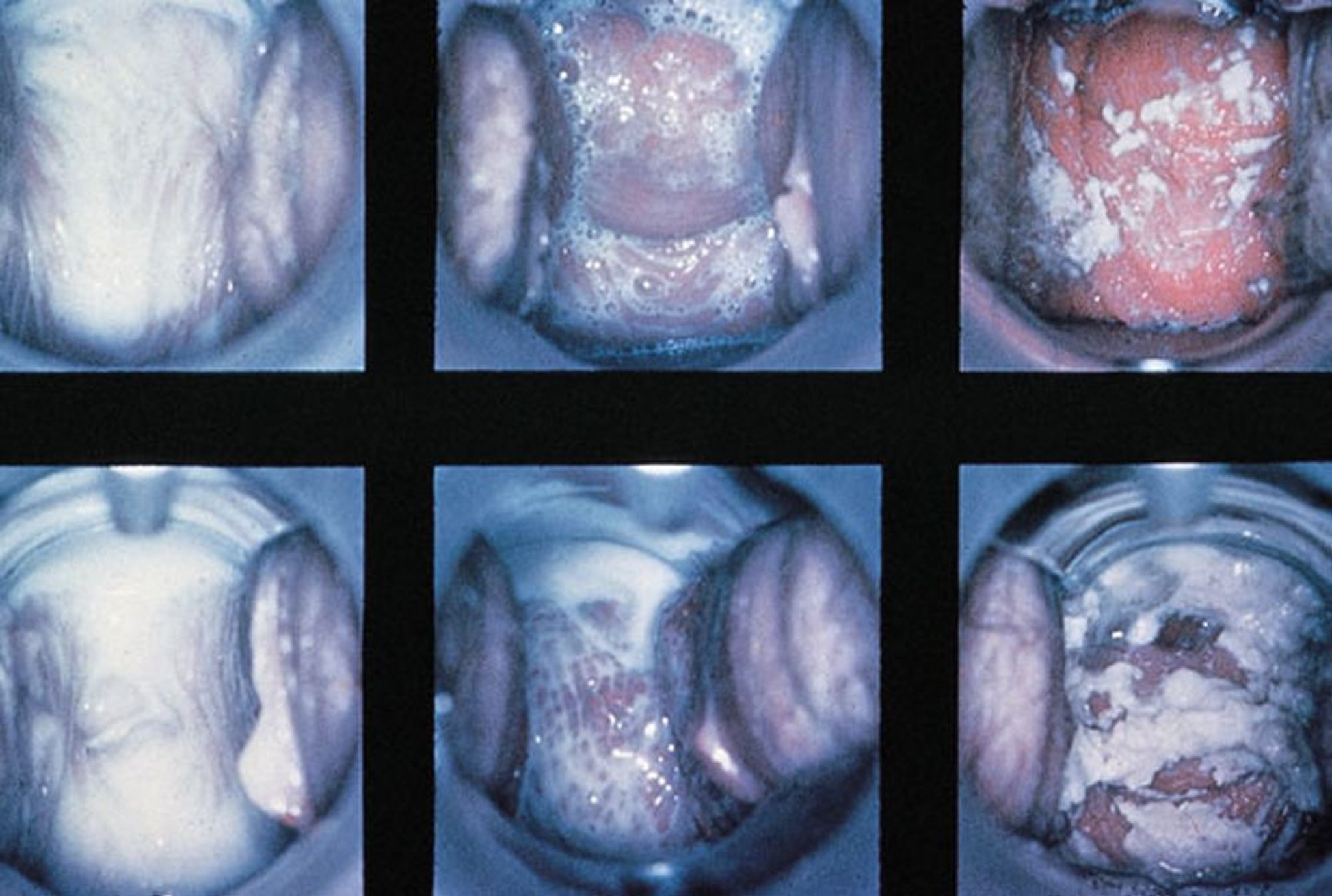 Exame especular na vaginite