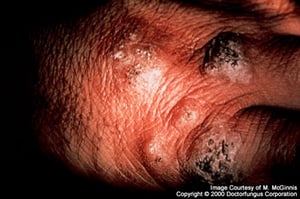 Sporotrichosis (Nodules)