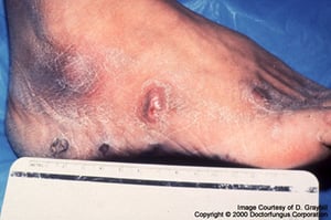Esporotricose (pápula)