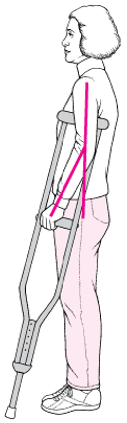 Подгонка подмышечных костылей