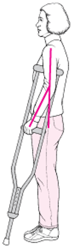 Регулювання підпахвових милиць