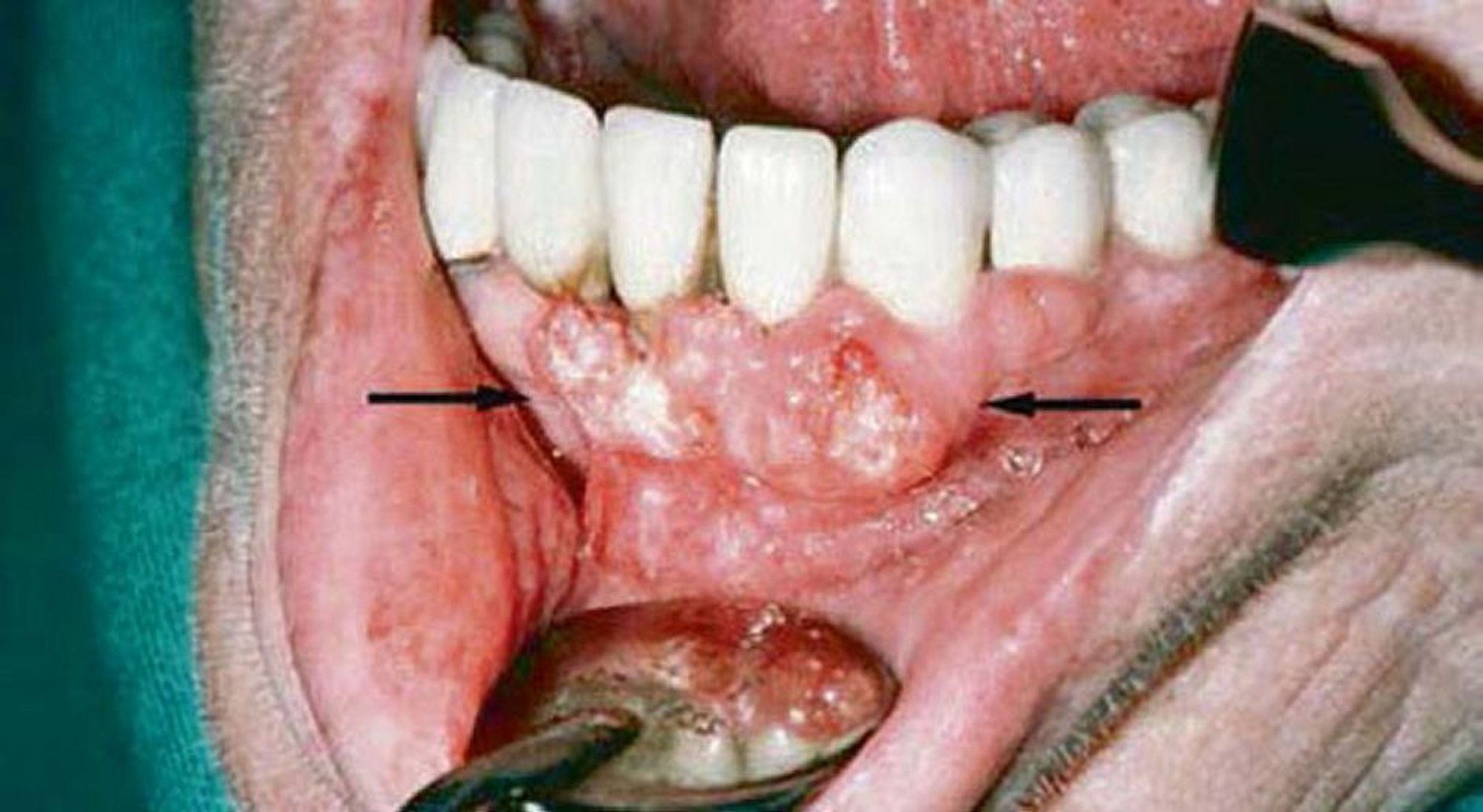 Carcinoma epidermoide (lesiones gingivales)