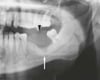 Carcinome malpighien de la mandibule