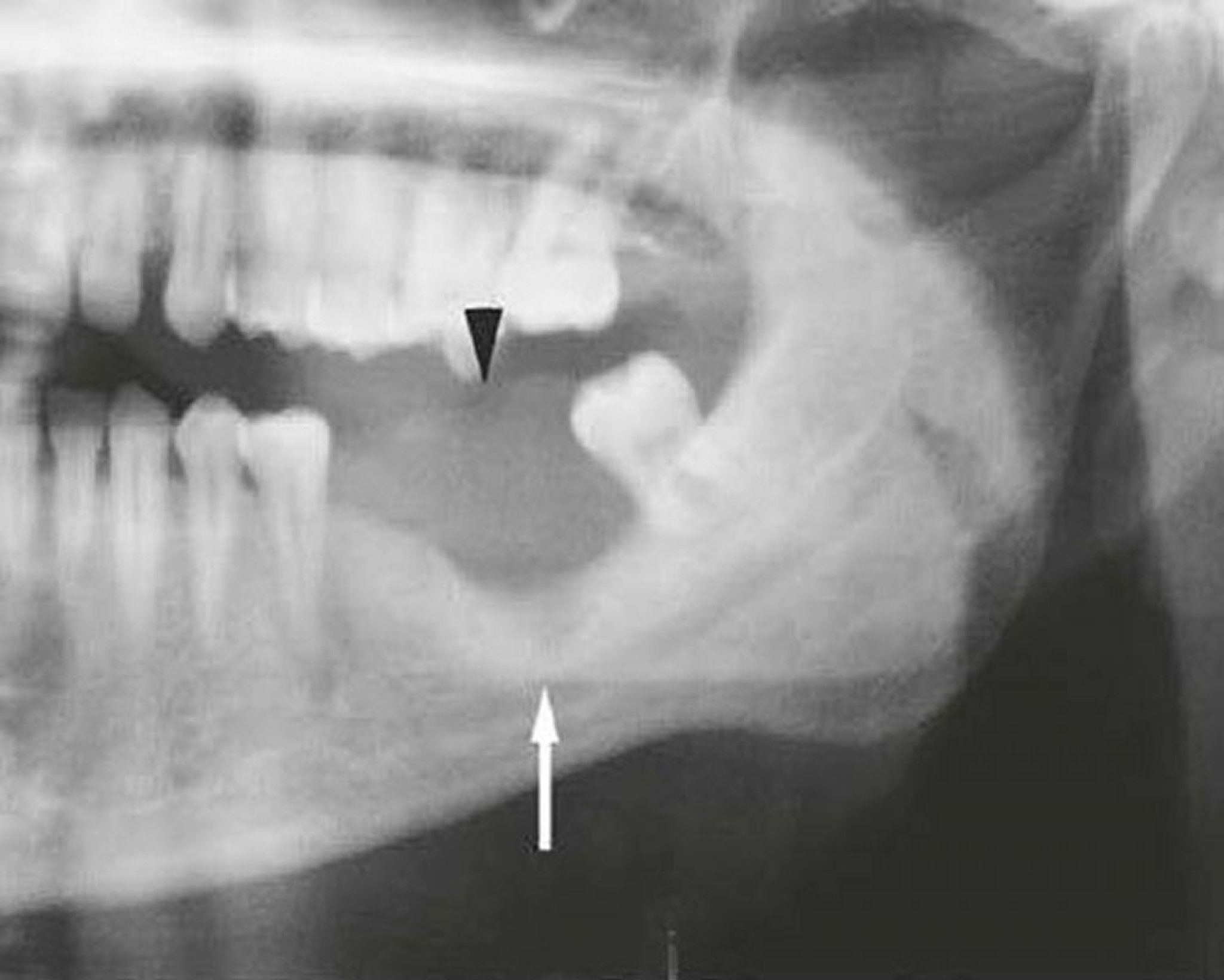 Carcinoma squamocellulare della mandibola