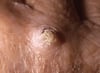 Squamous Cell Carcinoma (1)