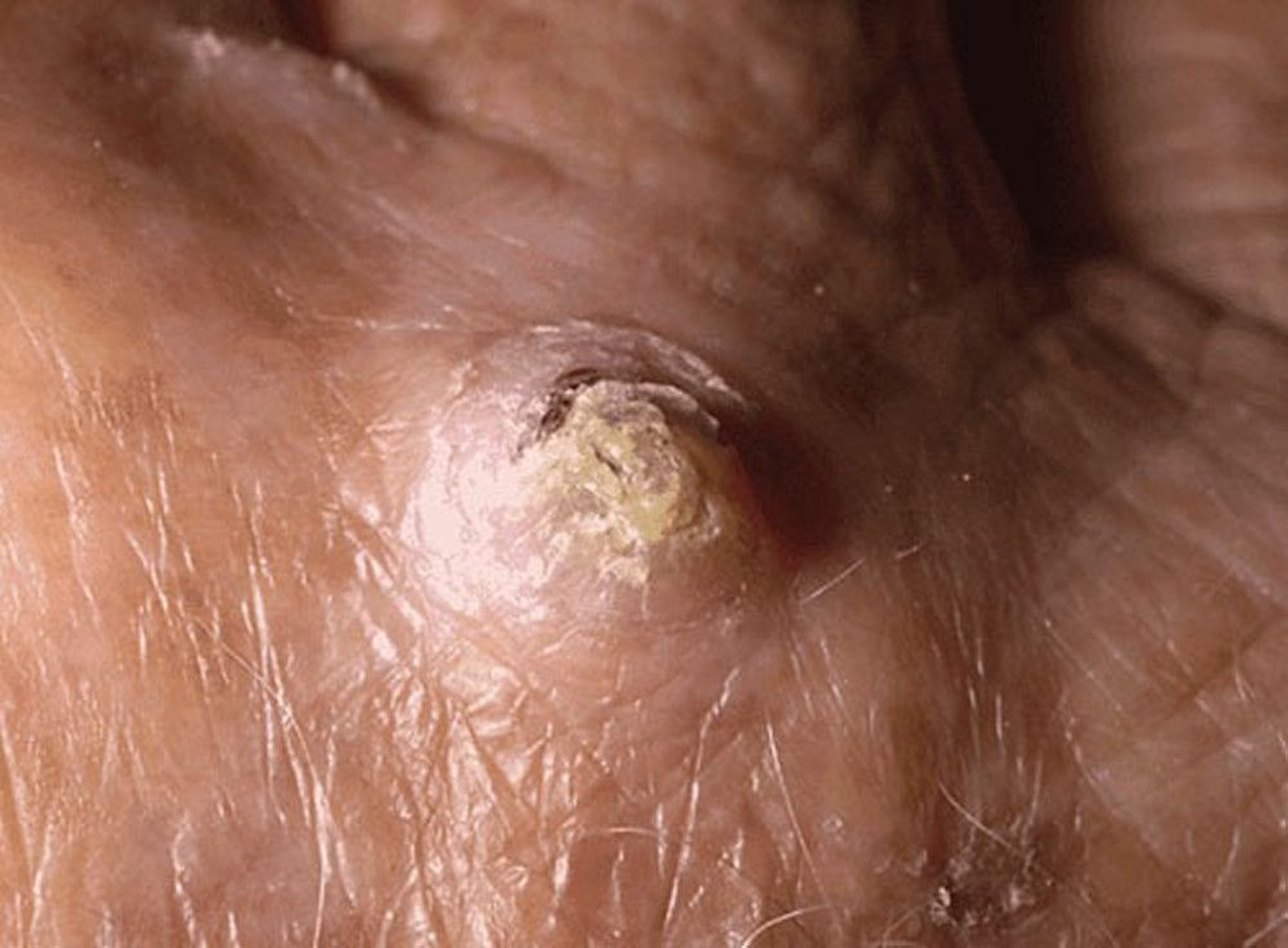 Squamous Cell Carcinoma (1)