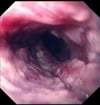 Carcinoma espinocelular do esôfago