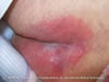 Stage 1 Pressure Injury (Buttocks)