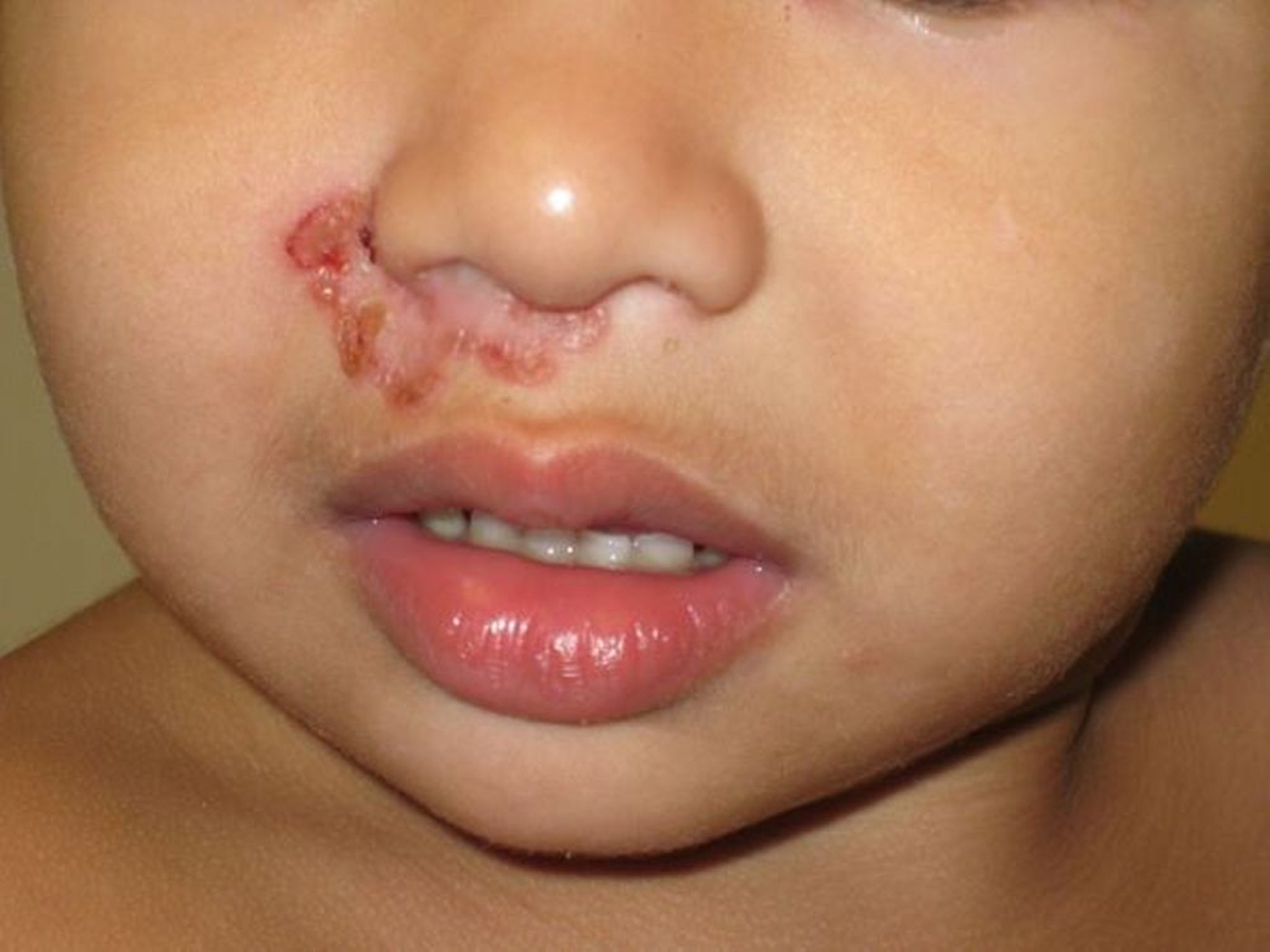 Impetigine non bollosa (bambino)