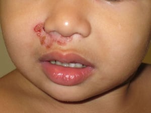 Impetigo não bolhoso (Criança)