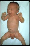Staphylococcal Scalded Skin Syndrome (Kind)