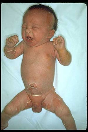 Стафилококковый синдром ошпаренной кожи (ребенок)