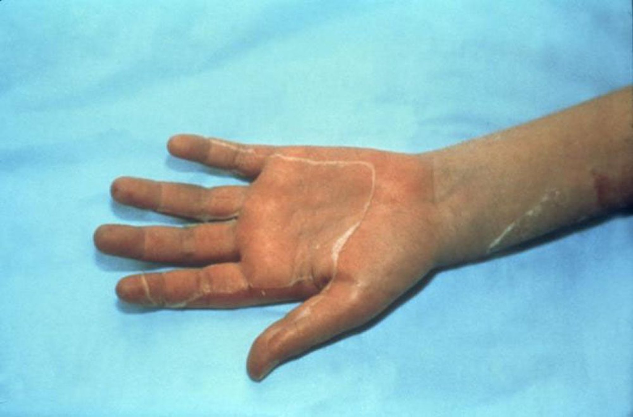 Staphylococcal Toxic Shock Syndrome