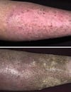 Stasis Dermatitis (Chronic Changes)